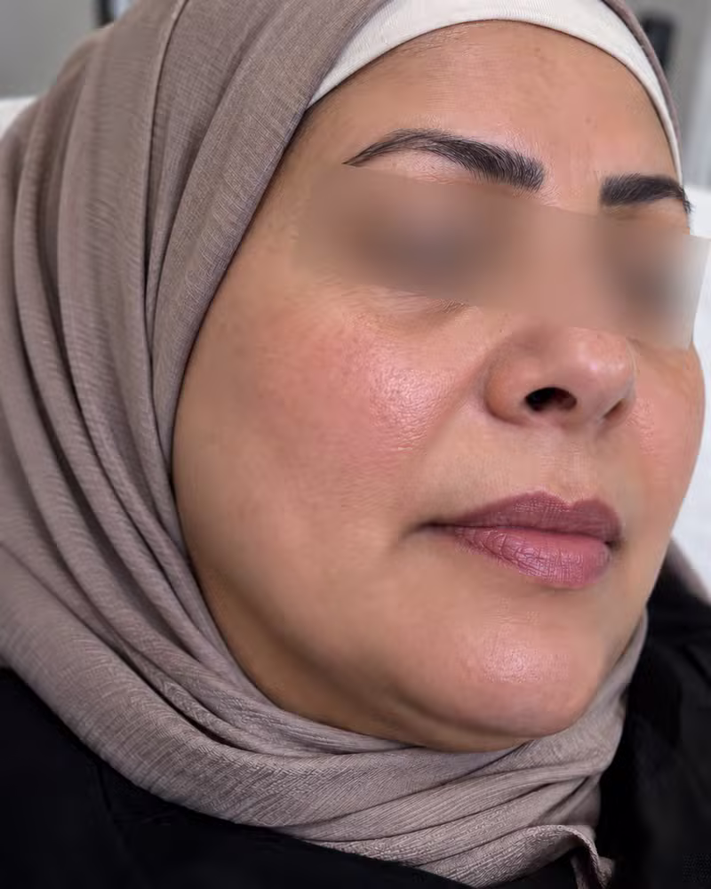 بعد ديرما بن