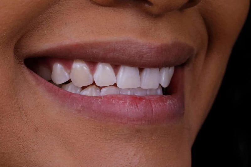 Blanqueamiento Dental