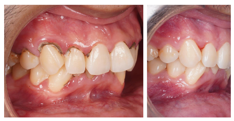 LIMPIEZA DENTAL