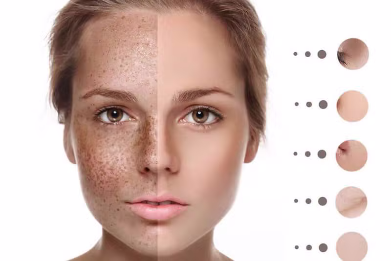 Pigmentation Treatment Services at VieMyne Beauty Lounge