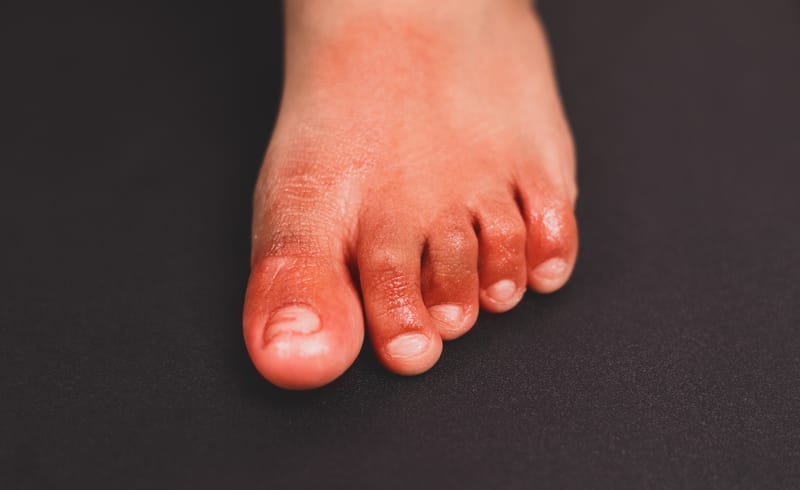 Chilblains (perniosis) - Winter Ailments: Part 2