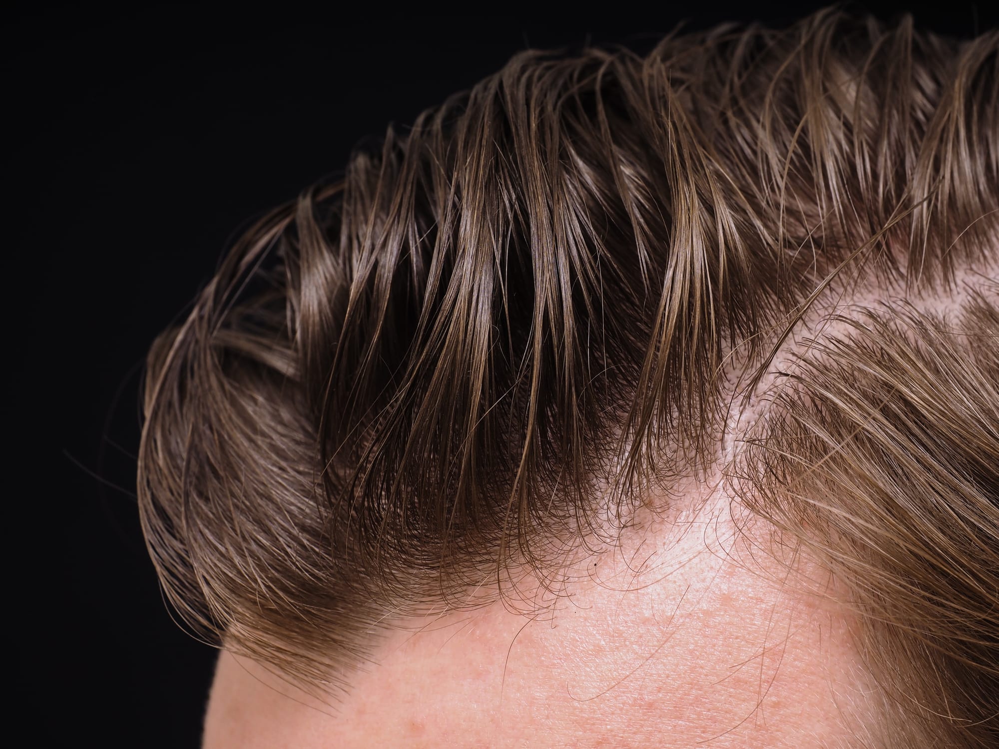 Top 10 Signs You Are Ready for a Hair System, and What to Do Next