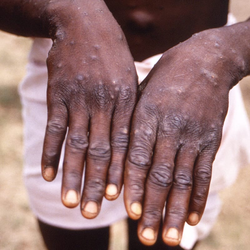 South Sudan Confirms First Mpox Case in the Country