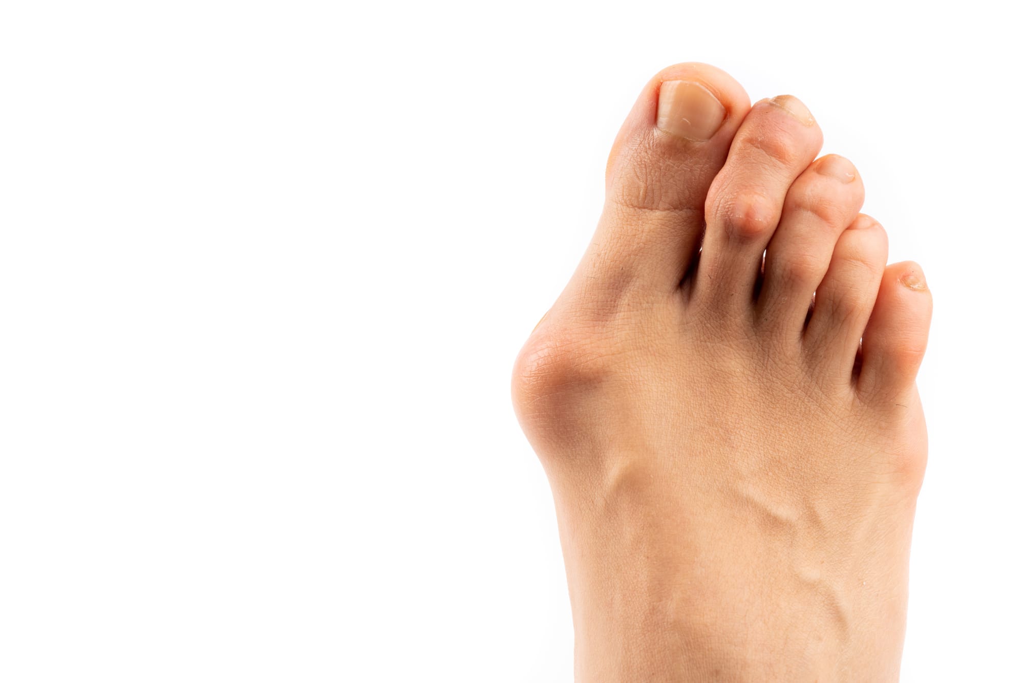 Hallux Valgus (Deformity of the Big Toe)