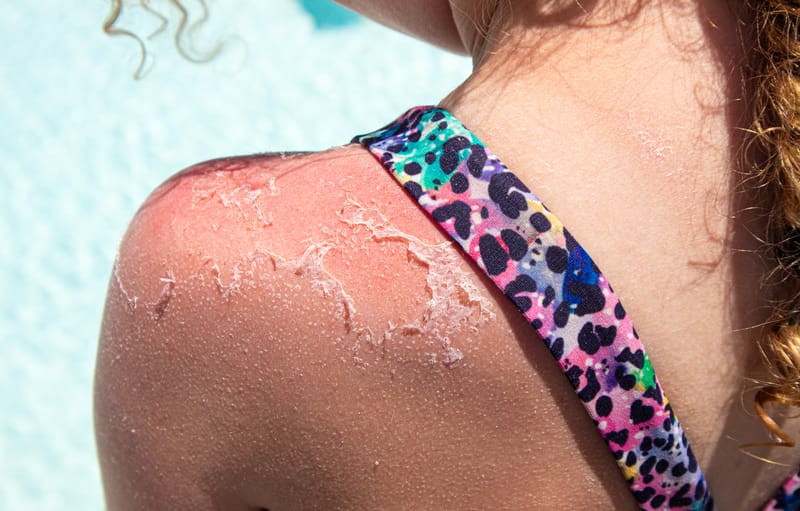 The 3 Most Common Types of Skin Cancer (And What Every Esthetician Should Know)