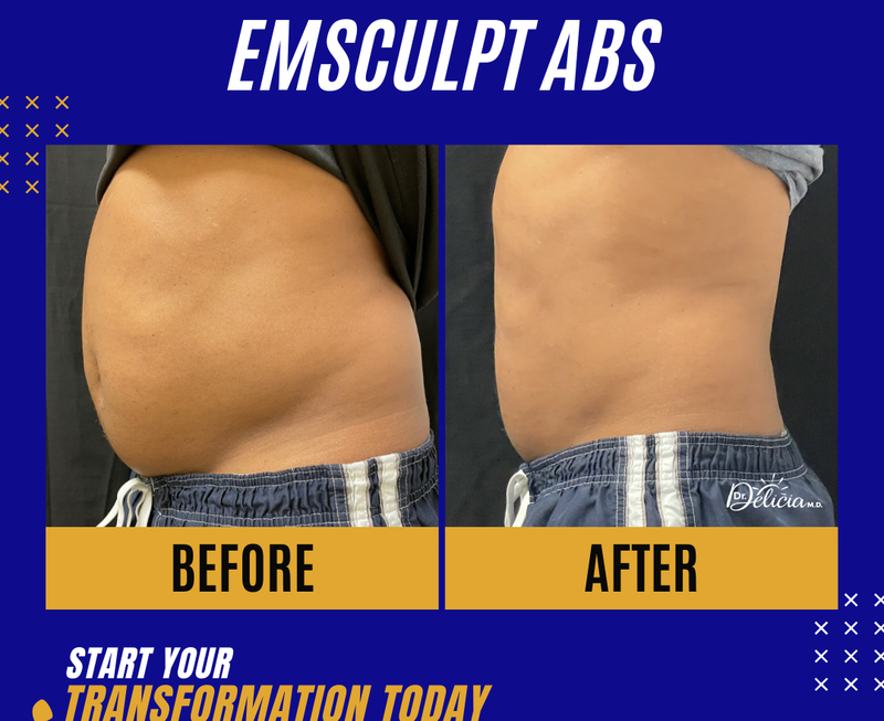 Fat burner and Muscle Builder (EMS Sculpt Neo)