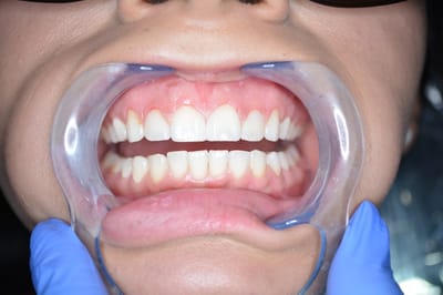 Why Choose Dental Implants After a Tooth Extraction?