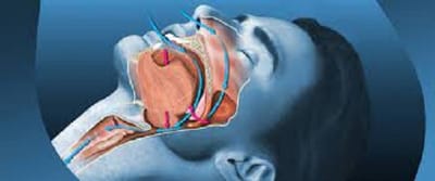 Top Signs You Need A Sleep Apnea Dentist