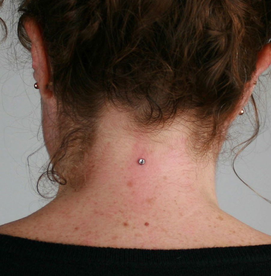 Microdermal nuque