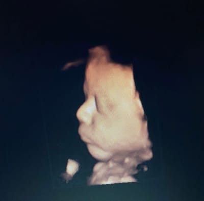 Ecografia 3D e 4 D image