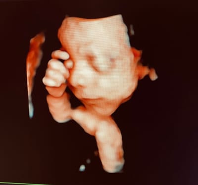 Ecografia 3D e 4 D image