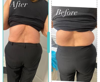 Lemon Bottle Fat Dissolver image