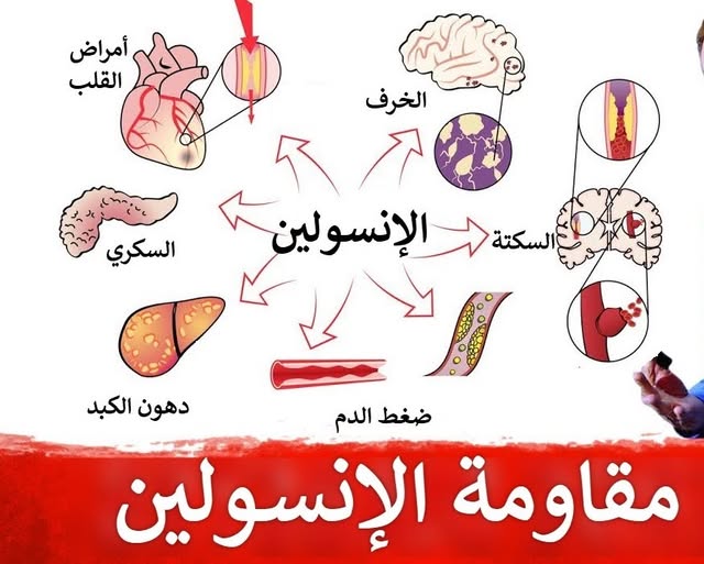 مقاومة_الإنسولين
#سكر_النوع_الثانى
#خلل_الهرمونات
#تكيسات_المبايض
#زيادة_الوزن