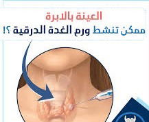 #عينة_الإبرة_الغدة_الدرقية
#المتهم_البرئ
#Fine_needle_aspiration_biopsy