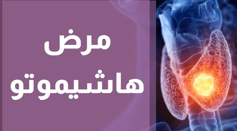 هاشيموتو#خمول_الغدة_الدرقية