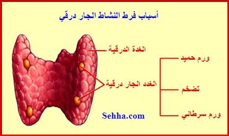 #فرط_نشاط_الغدة_الجار_درقية #Hyperparathyroidism  هو زيادة في هرمون الغدة الجار درقية #PTH  ا
