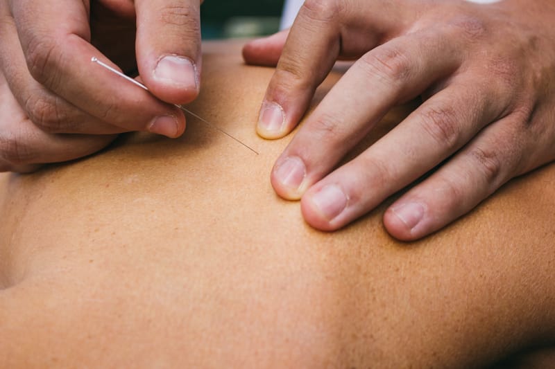 DRY NEEDLING