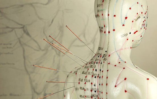 ש.ל.ה - כללית רפואה משלימה על 6 היתרונות של הדיקור הסיני