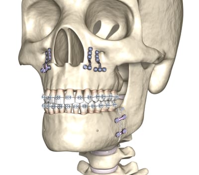 CHIRURGIE MAXILLO-FACIALE