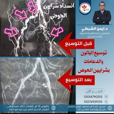 توسيع شرايين الطرفين امل جديد لانقاذ القدم السكري