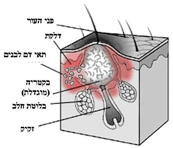 טיפול פנים לאקנה