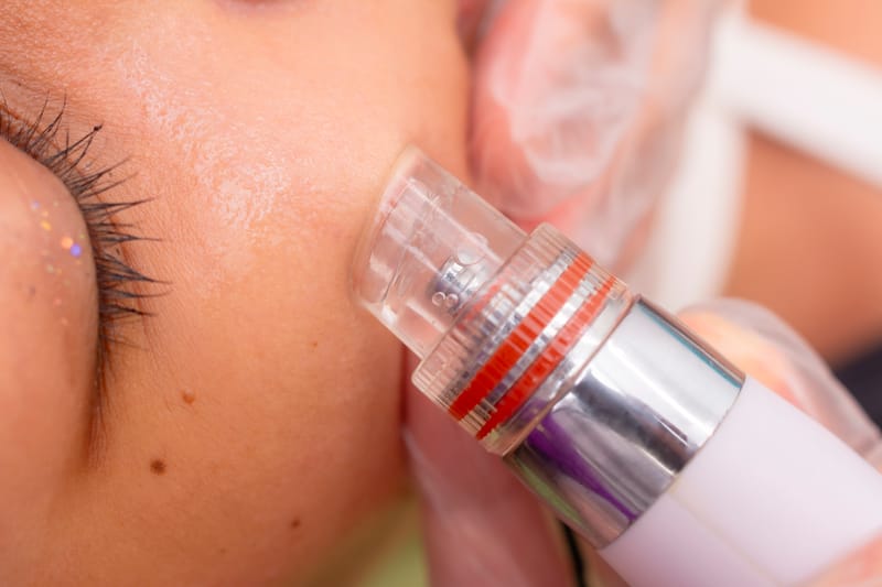 Limpieza hidrodermoabrasión