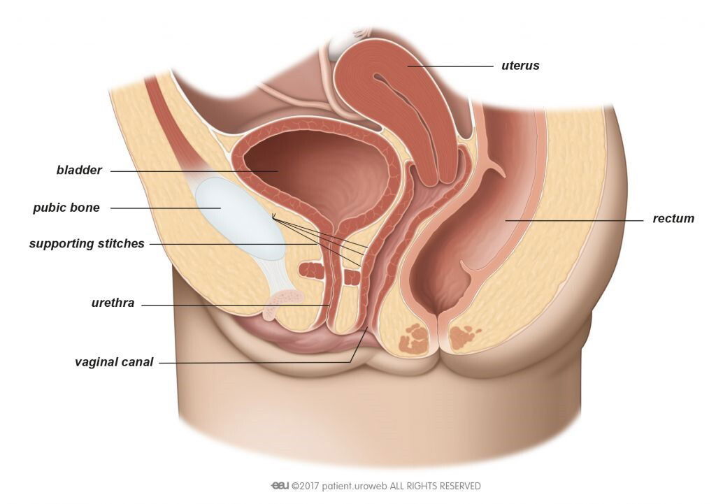 Fig. 1: In Burch colposuspension supporting stitches lift the bladder neck.