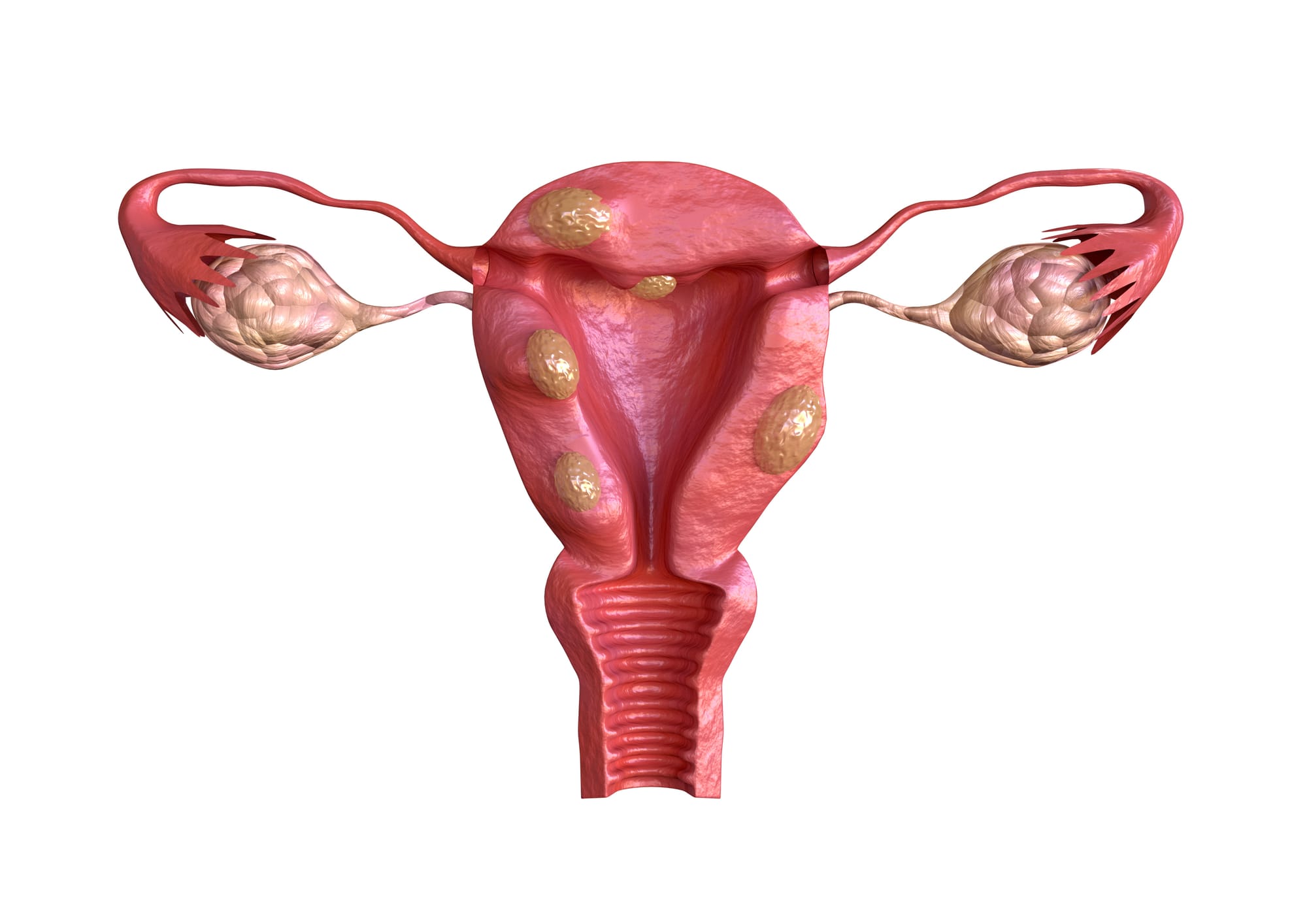 Deaing with Fibroids