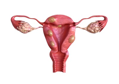 Síntomas de fibromas uterinos: calidad de vida