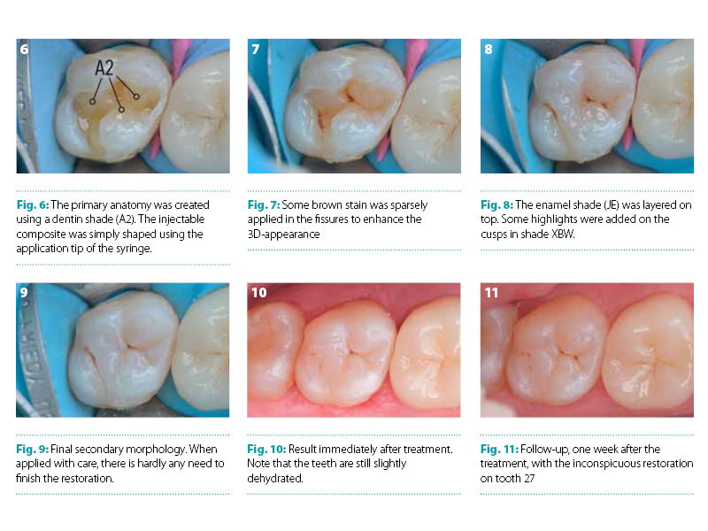 Injectable Composite