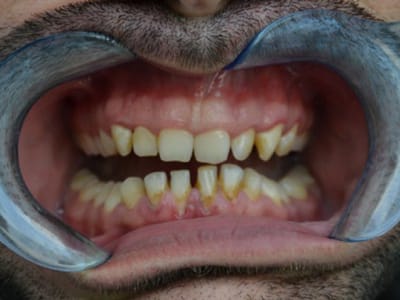 Clearfil Majesty ES-2 Universal CC