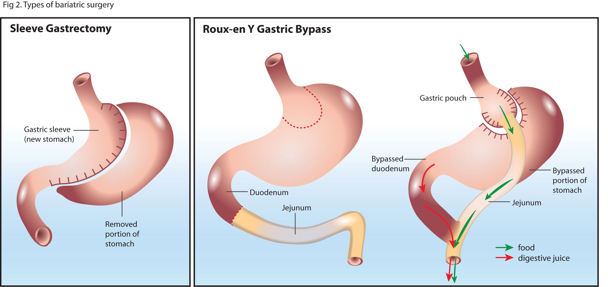 gastric balloon Melbourne