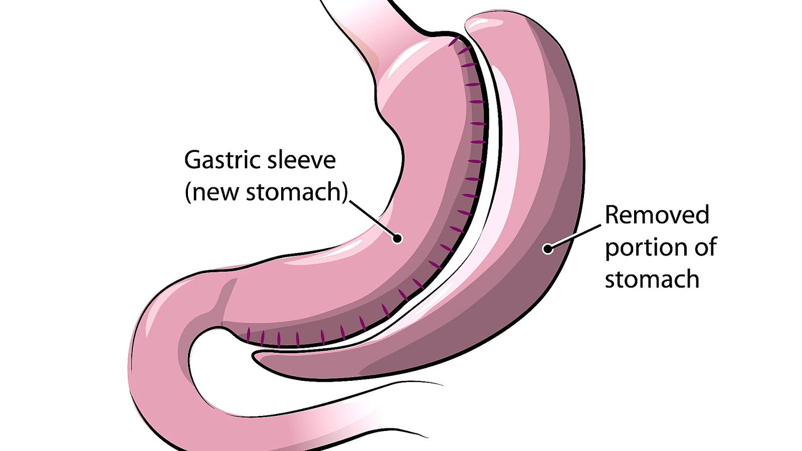 gastric sleeve surgery Melbourne