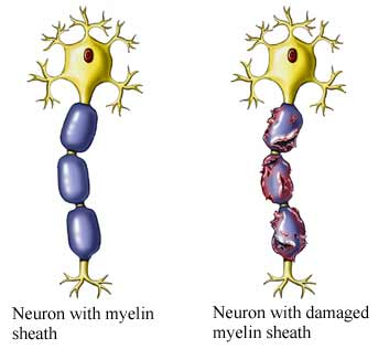 Multiple-Sclerosis and meditation case study_UVA health