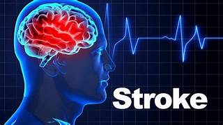Stroke / Hypnointervention. FAST