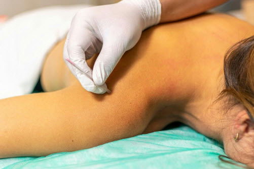 Your Undercover Apparatus for Treating Back Pain: Dry Needling in Singapore