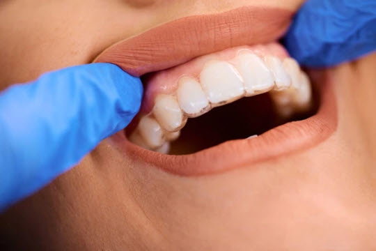 Orthodontic Choices: Teen Aligners vs Braces