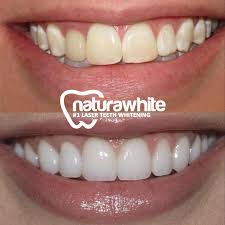 Teeth Whitening