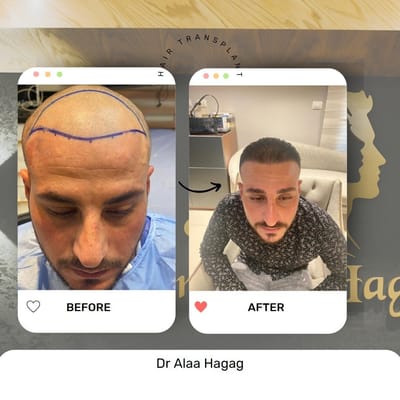 مركز زرع الشعر في مصر