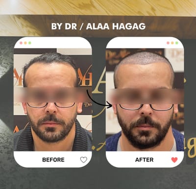 مراكز زراعة الشعر
