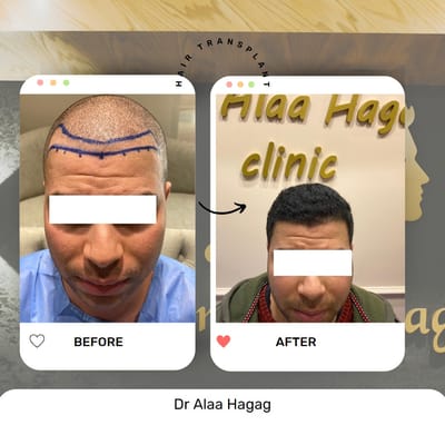 زراعة الشعر في مدينتي