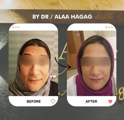 من البوتكس إلى زراعة الشعر: تقنيات طبية تمنحك مظهرًا أكثر شبابًا