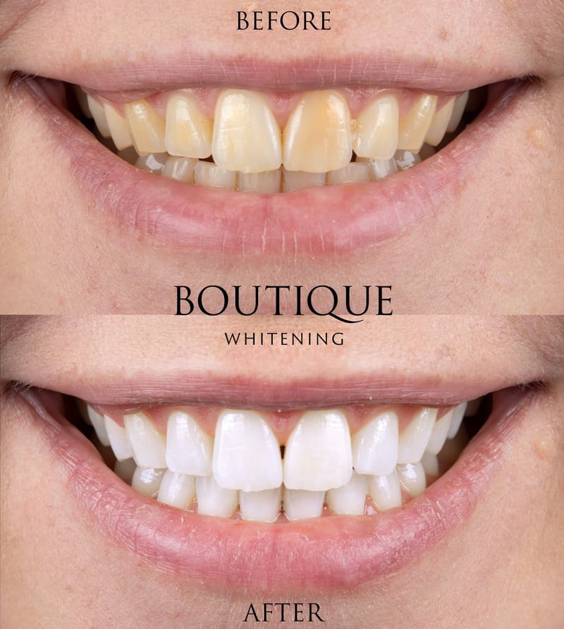 Tooth Whitening - Upper and Lower arches