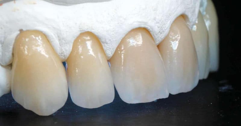 Layered Zirconia crown