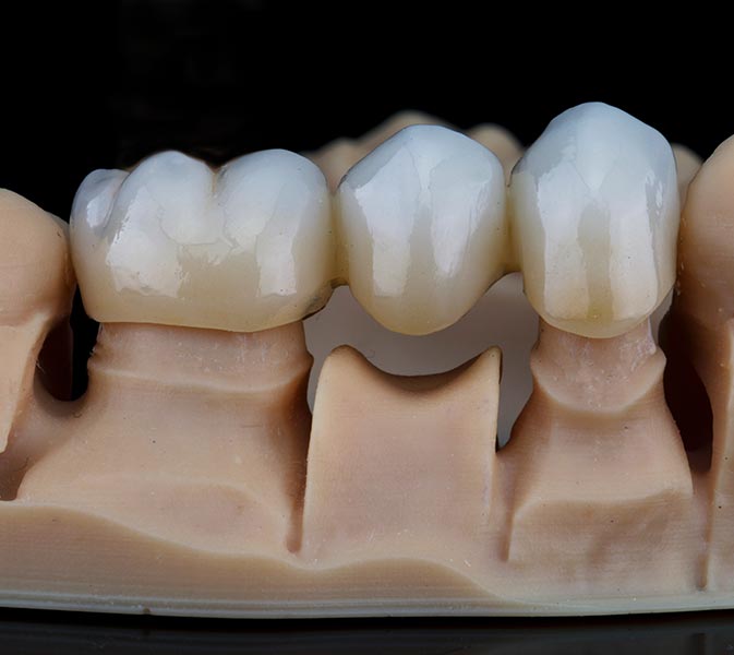 Conventional Bridge unit