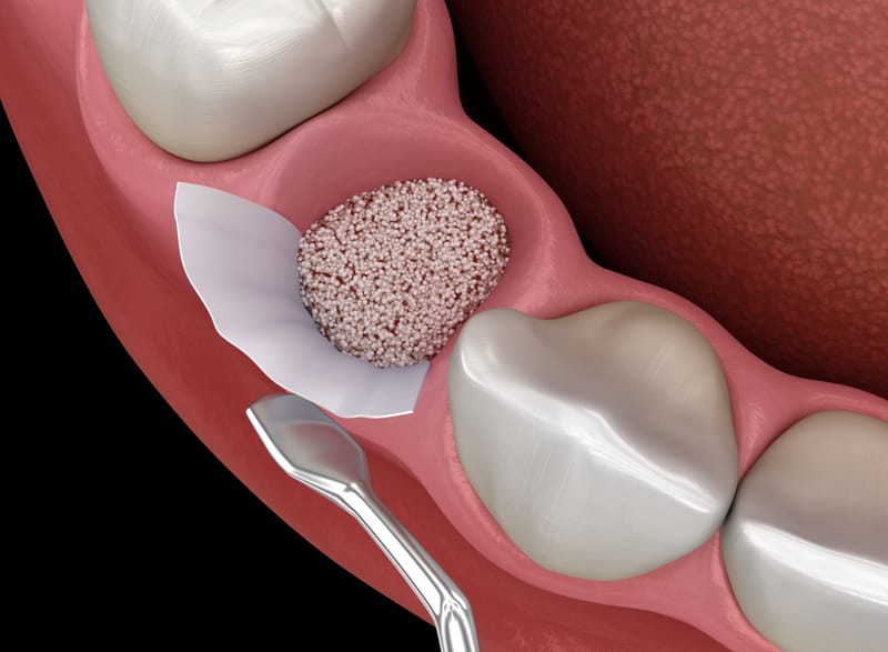 Bone augmentation