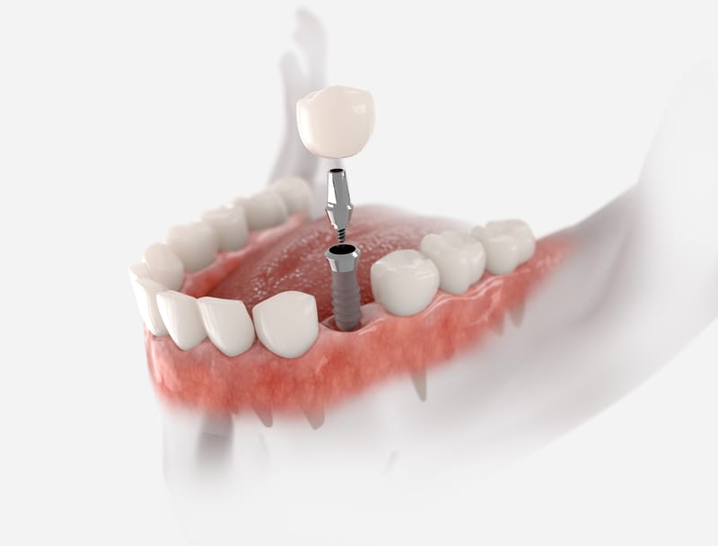 Dental implant crown