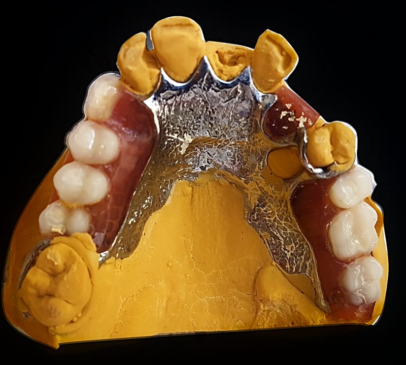 Cobalt chromium denture