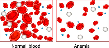 Anemia of Inflammation or Chronic Disease | NIDDK