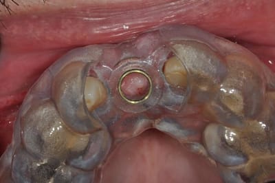 Implantes com planejamento digital e cirurgia guiada image